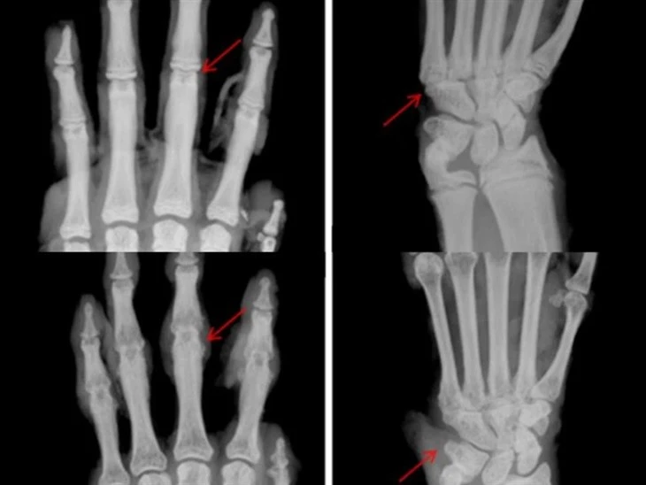 Modell der rheumatoiden Arthritis (RA).